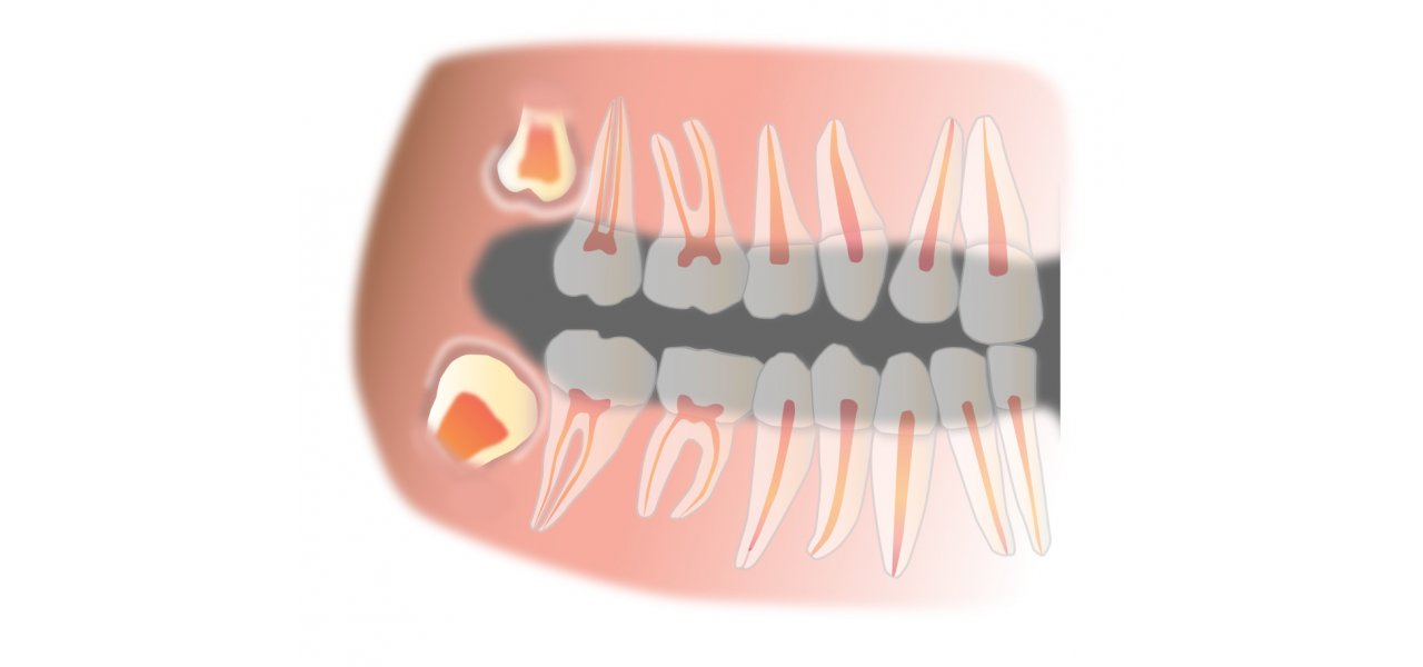 Extraction of Impacted Wisdom Teeth