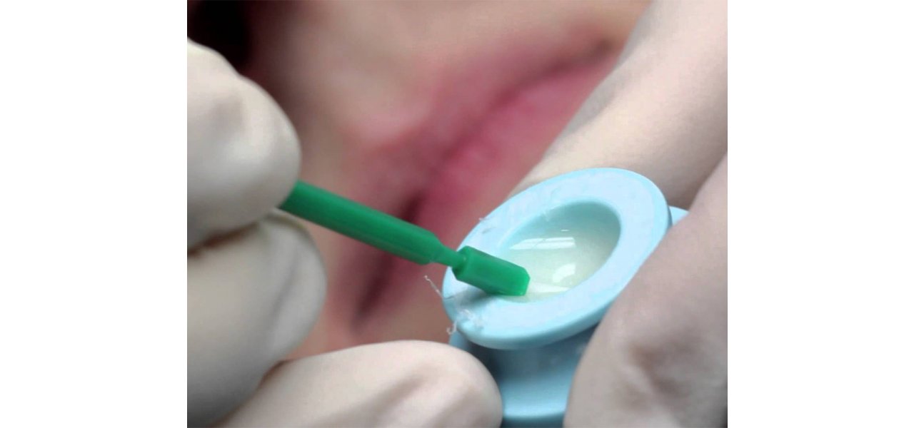 Fluoridbehandlung