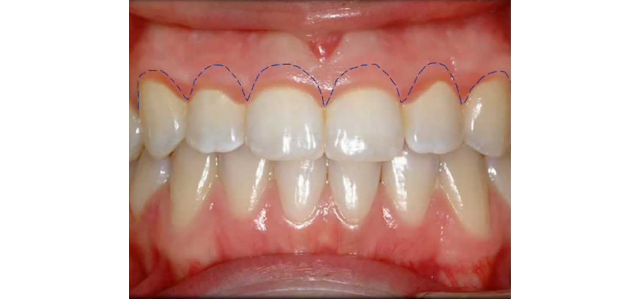 Gingivale Ästhetik