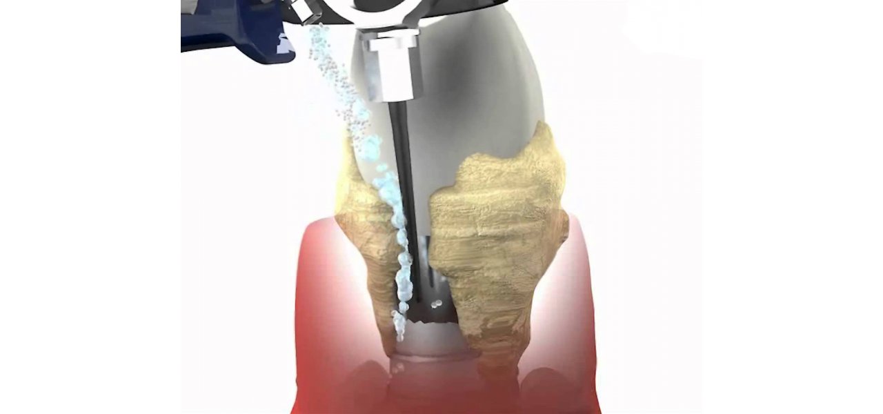 Peri Implantitis