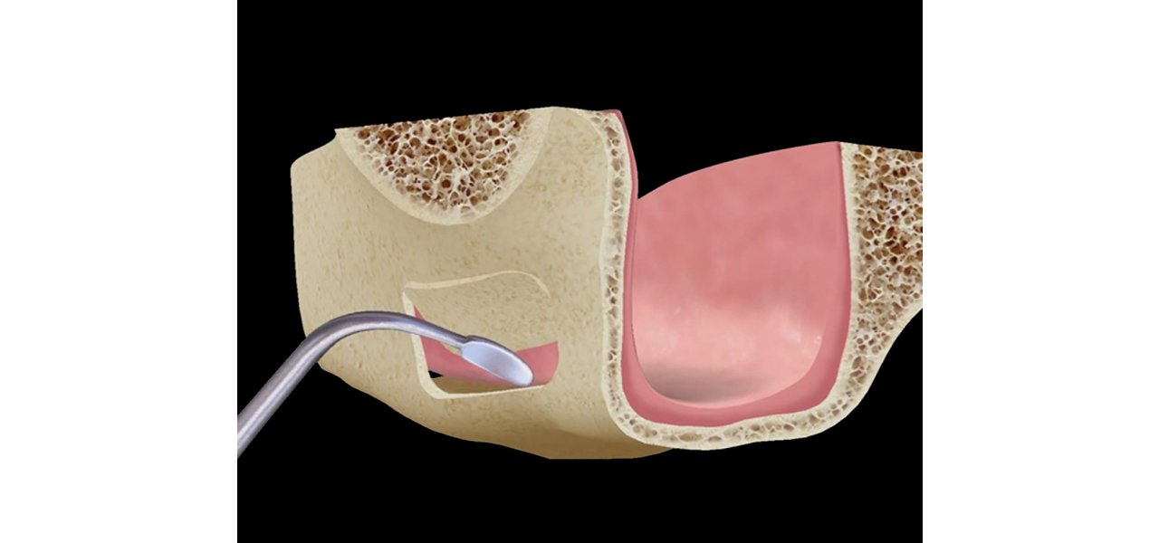 Sinus Lift