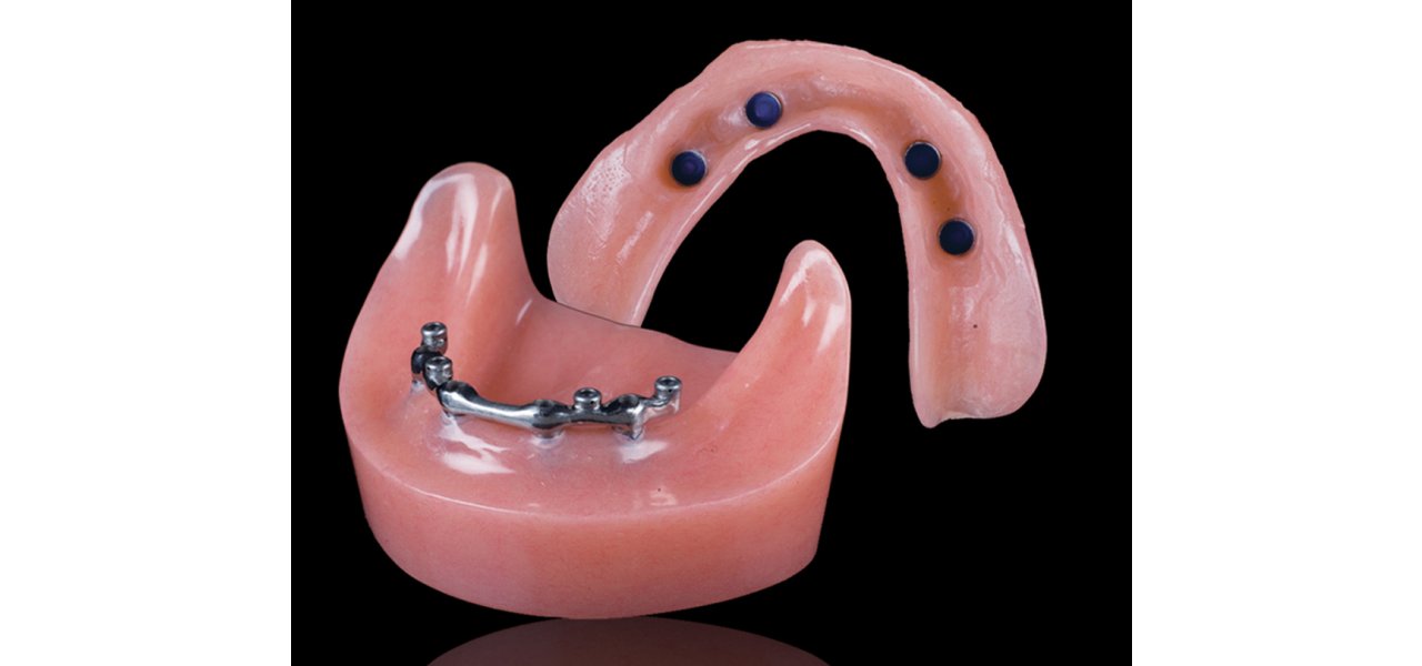 Implant Supported Removable Dentures