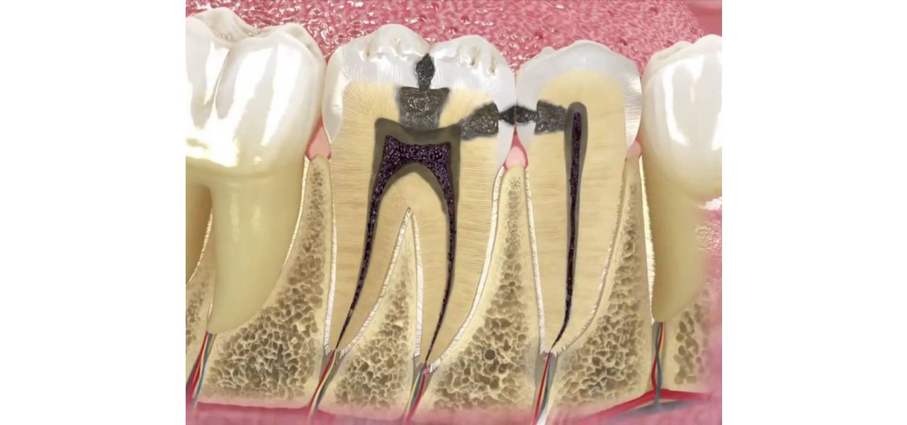 Root Canal Treatment