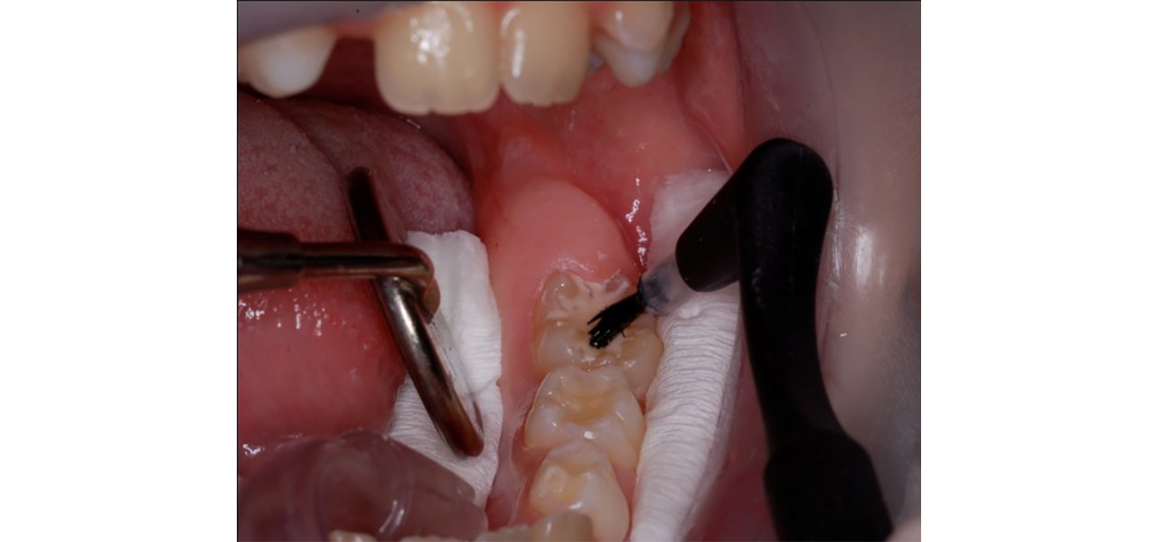 Fissure Sealants