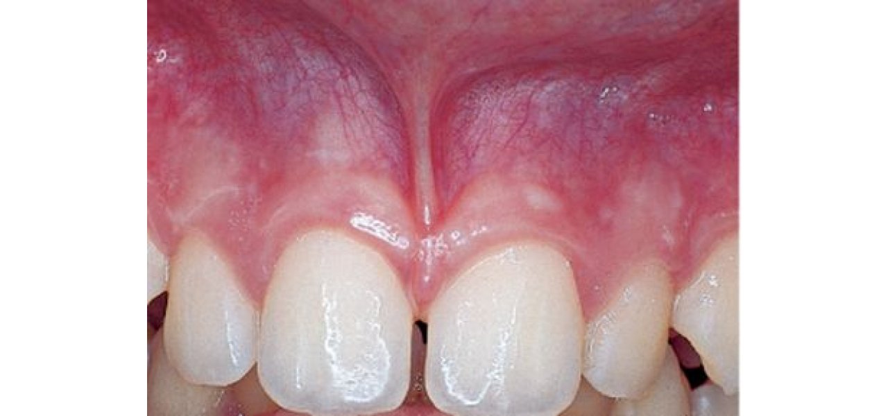 Frenotomy - Frenectomy