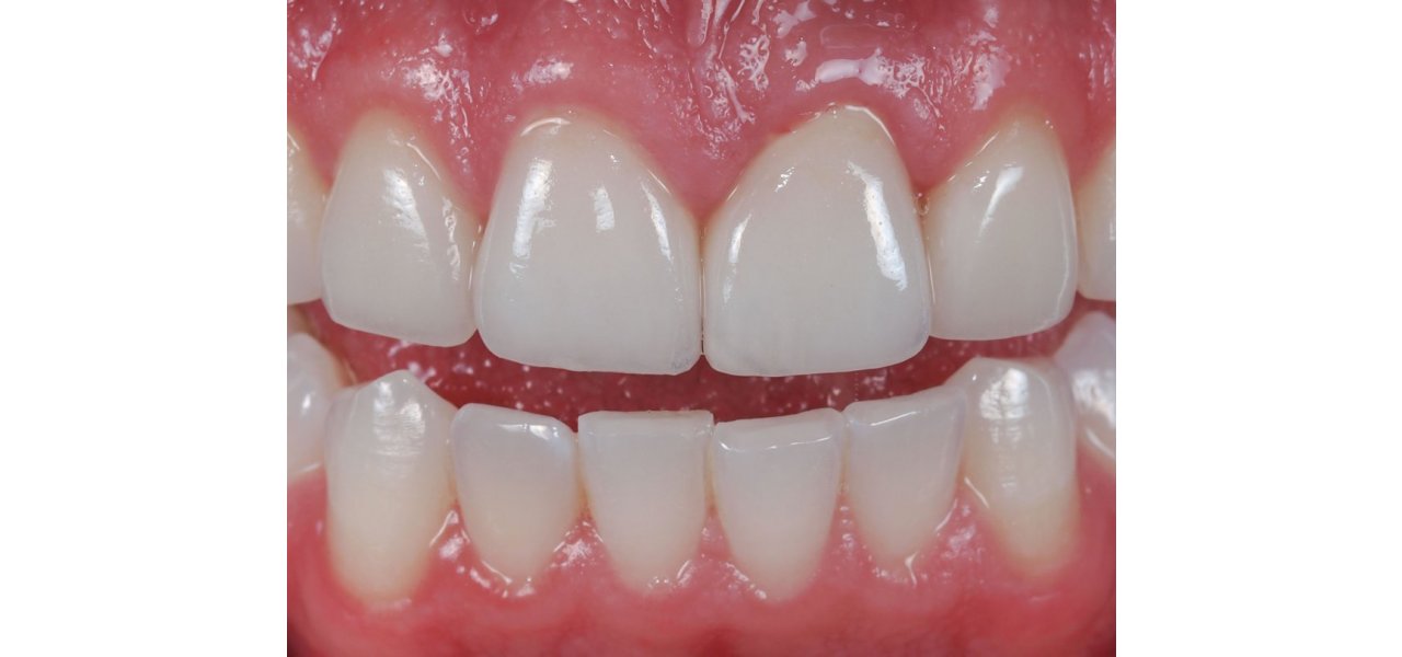 Full Ceramic Crowns