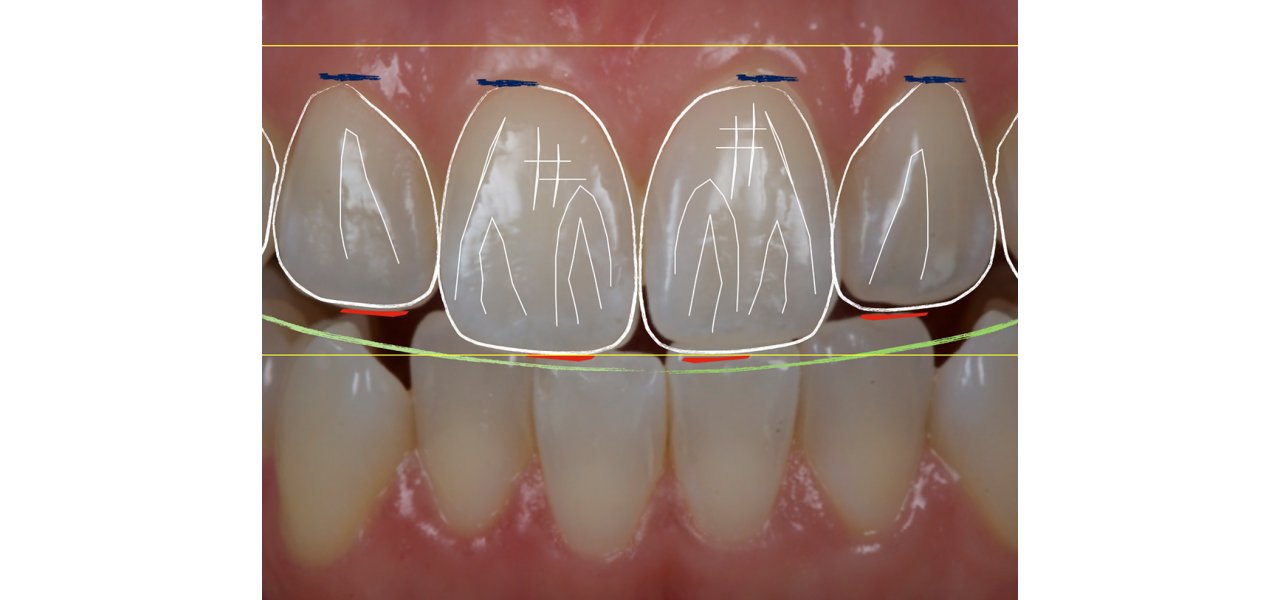 Smile Design