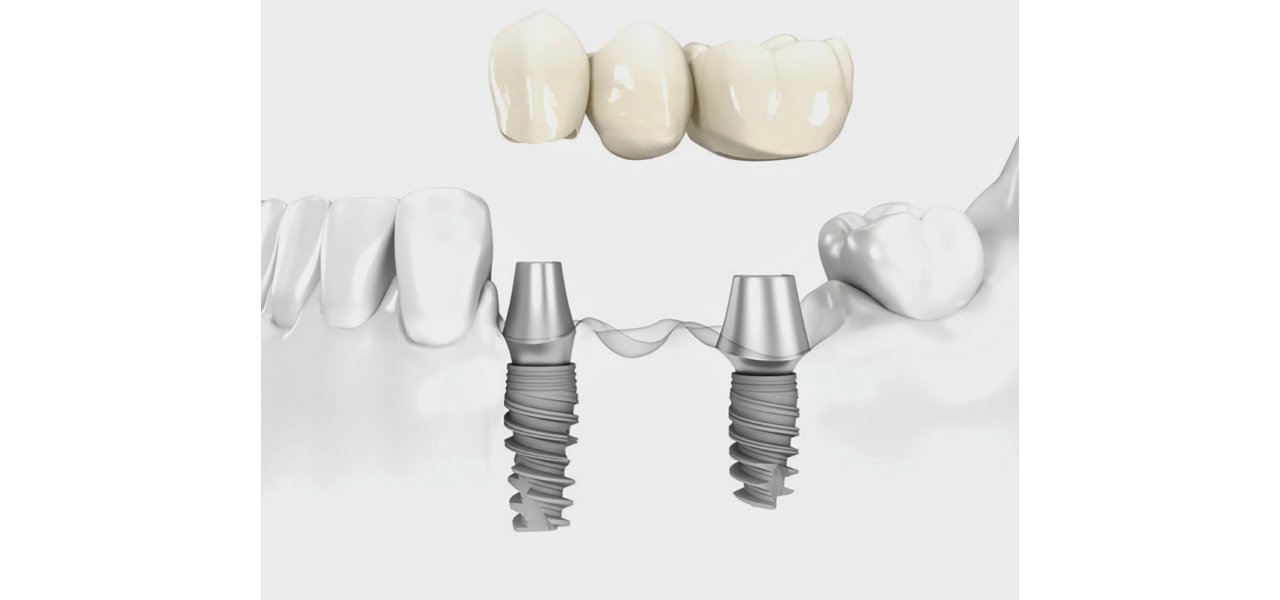 Implant Supported Fixed Dentures