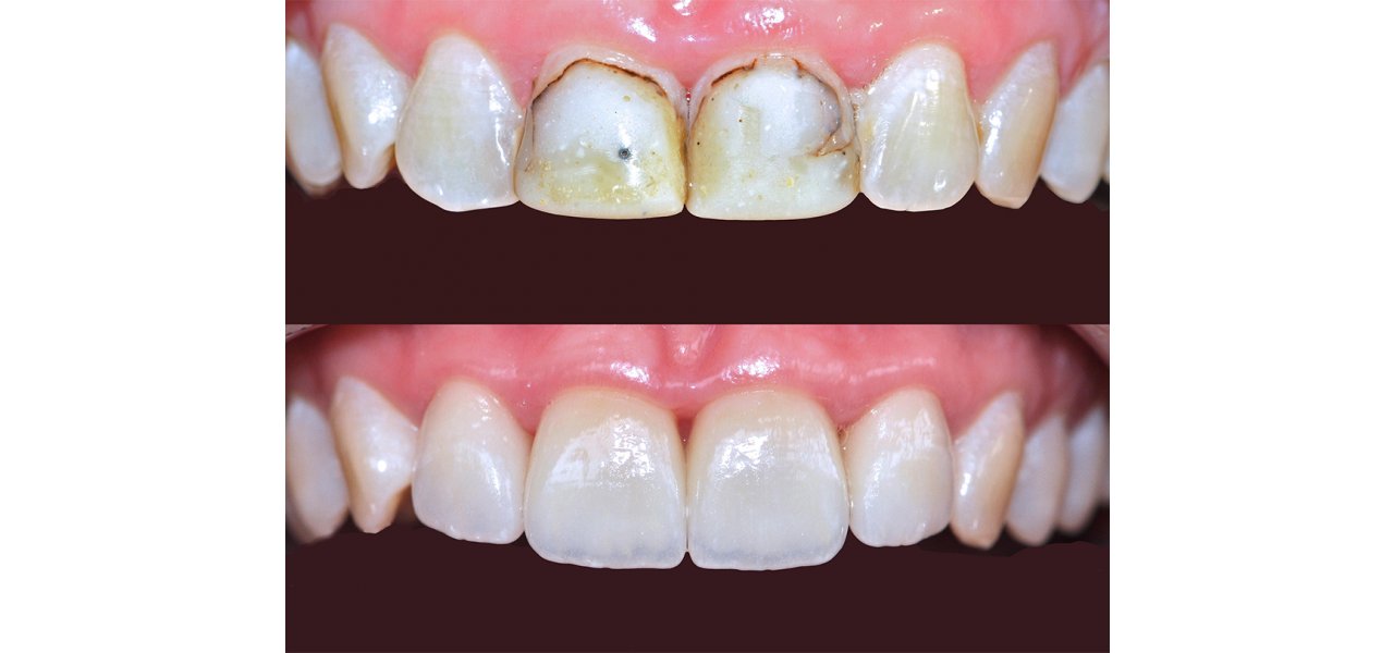 Composite Fillings